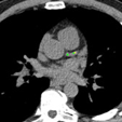 Distribution of coronary artery calcium volume and density by age, sex, and race using AI-based quantification algorithm